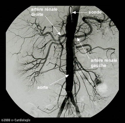 E Cardiologie L art riographie R sultats E Cardiologie L art riographie R sultats